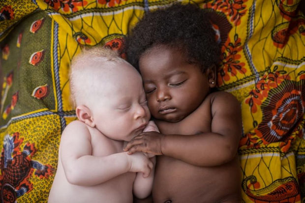 29 Powerful Pictures - A 3-week-old infant with albinism snuggles up to his cousin for a nap.