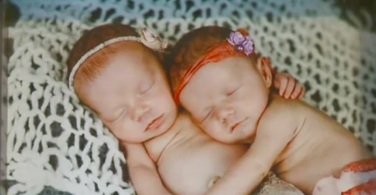 Born at Just 33 Weeks, Rare Twins Were Born. Then, Doctors Noticed Their Hands…Wow!