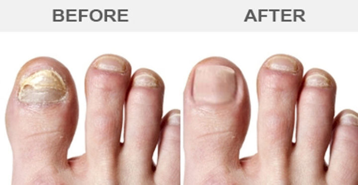 11 Vicks Vaporub Uses - Cure your fungus nails.