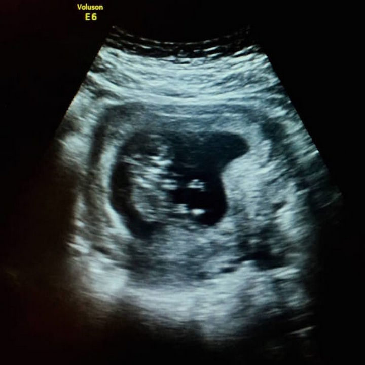 Three scans later, I’ve even heard the heartbeat, like a hummingbird, and it’s beautiful.