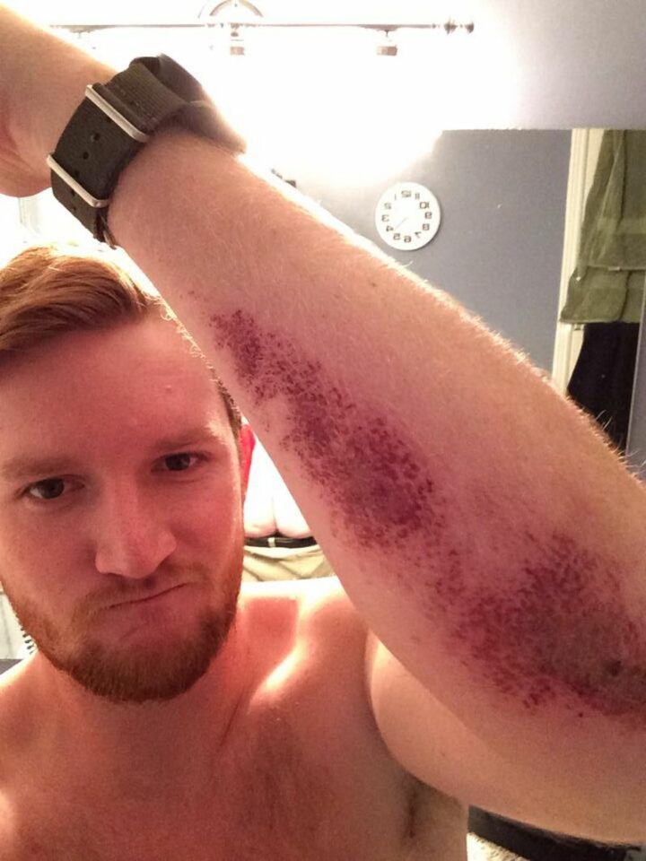 "Buddy sent us a picture of his turf burn. When you see it..."